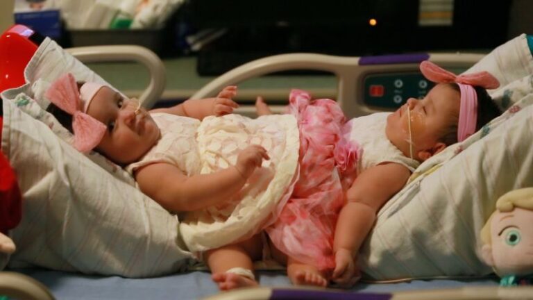 Conjoined Twins Fast Facts | CNN